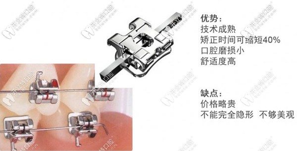 固定鋼絲牙套的特點(diǎn)