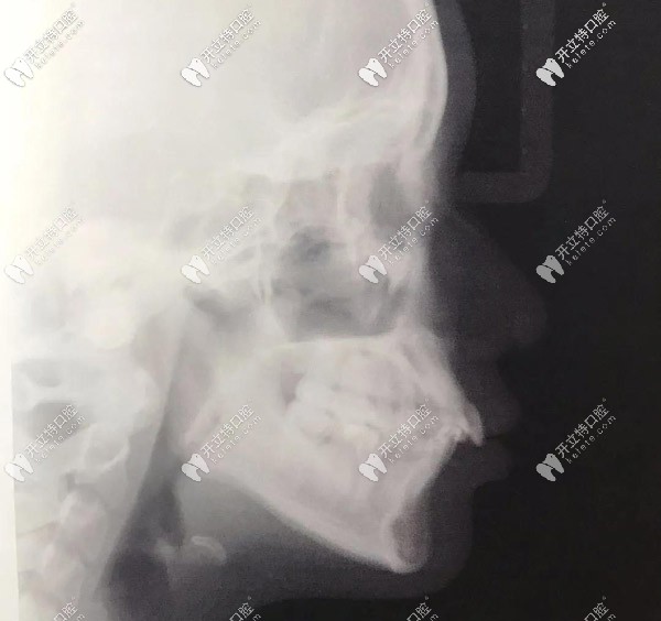 側(cè)面X光，門牙唇傾很厲害的