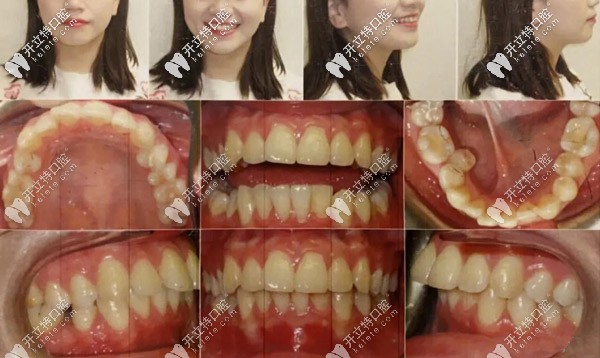 正面、側(cè)面照，記錄牙齒的變化情況