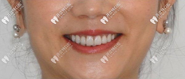 做前牙美學(xué)貼面后 做前牙美學(xué)貼面后