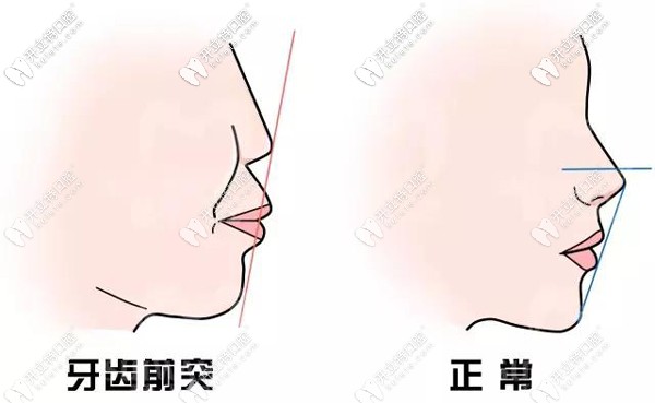 通過整牙可以改變嘴凸