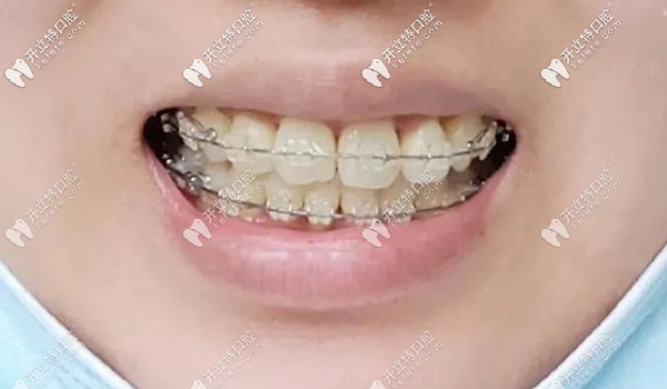 戴冰晶托槽矯正一年半的效果
