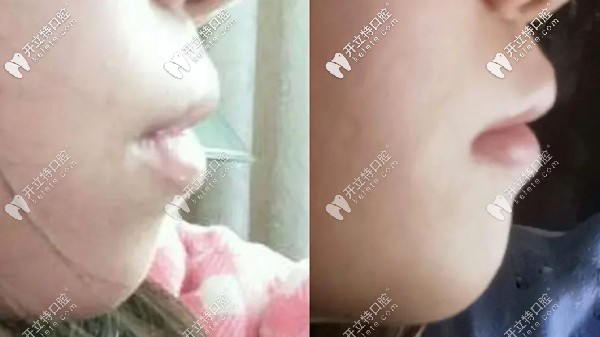 戴牙套可以治療嘴突?且看小姐姐通過整牙改變凸嘴的效果
