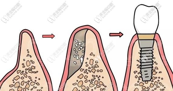 種植牙植骨粉示意圖