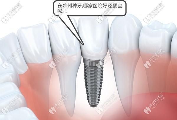 關(guān)于廣州哪家醫(yī)院做種植牙的價格便宜又好,都在此攻略