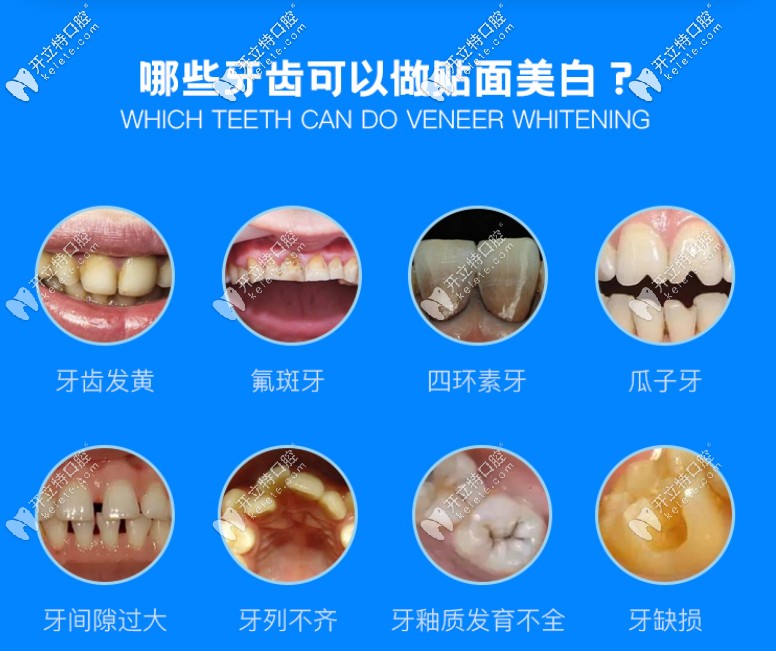 哪些牙適合做貼面美白