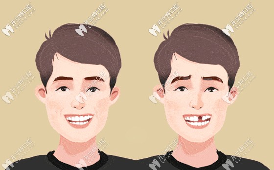 種牙前后效果圖