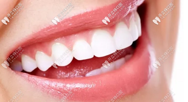 什么是牙齒貼面