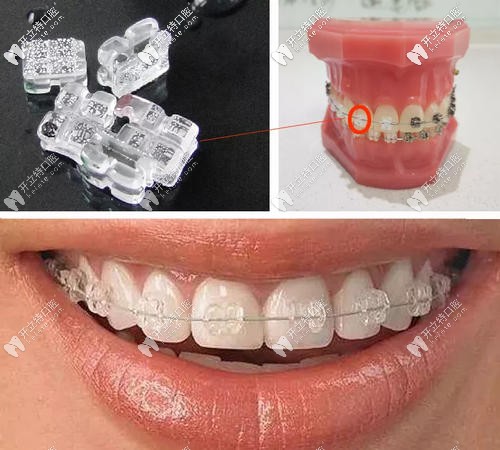 陶瓷半隱形矯正