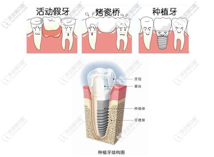種植牙的結(jié)構(gòu)