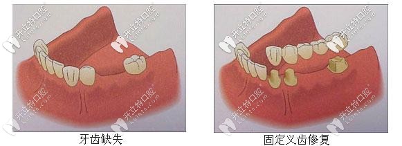 固定義齒修復(fù)
