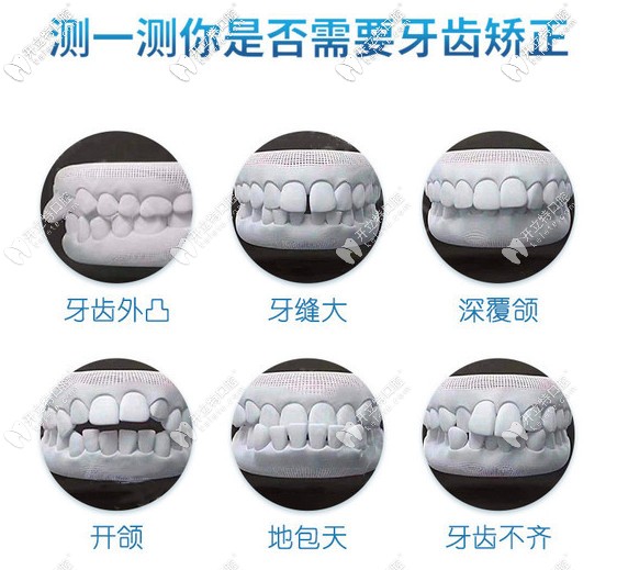 了解你是否需要牙齒矯正