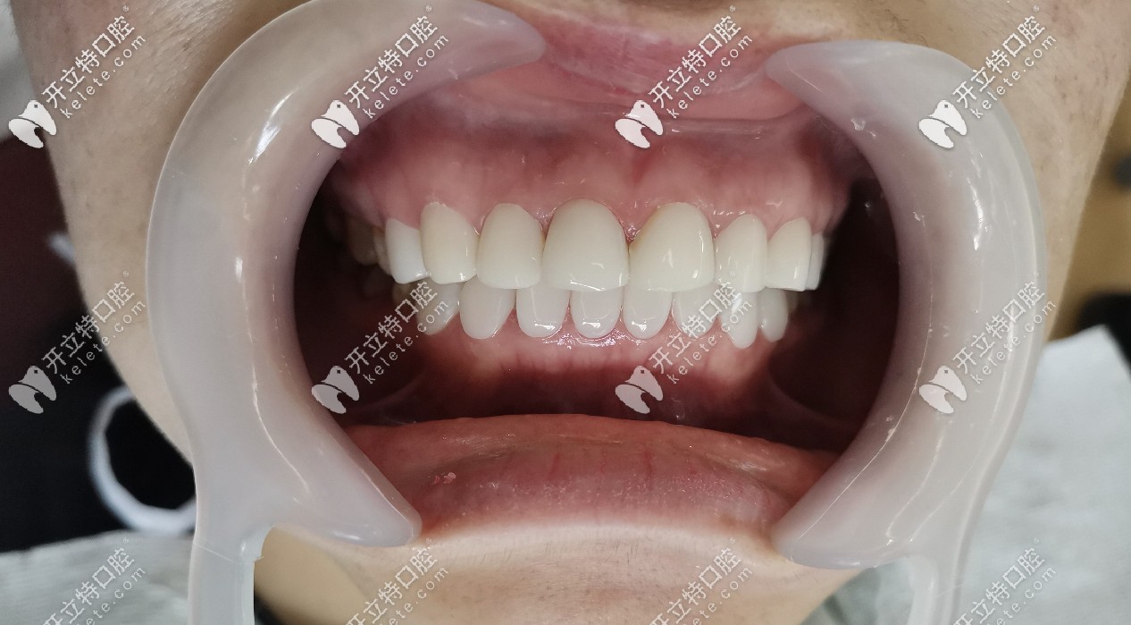 牙齒美白后的圖片 牙齒美白后的圖片