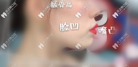 顴骨高、面部凹陷、凸嘴