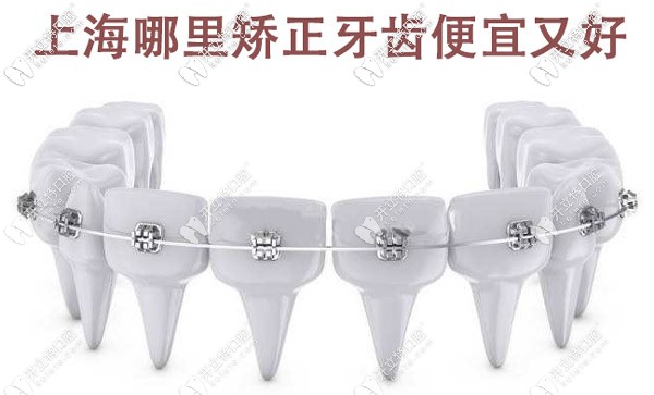 上海哪里矯正牙齒便宜又好，這些有名的牙科醫(yī)院值得選擇
