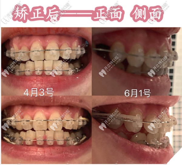 陶瓷半隱形矯正2個(gè)月