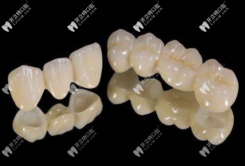 全瓷牙冠外觀