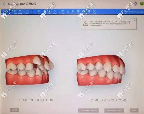 無(wú)托槽隱形矯正器的特點(diǎn)