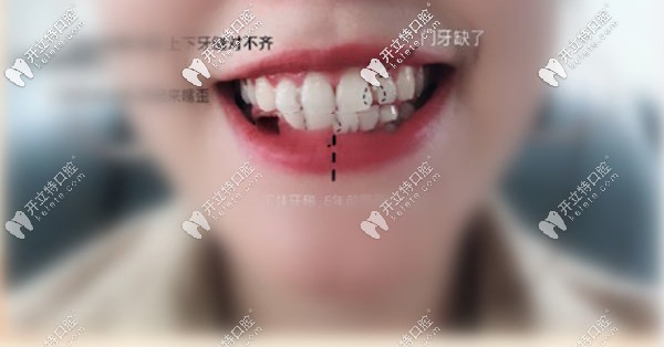我的牙齒矯正前上下牙中線對(duì)不齊