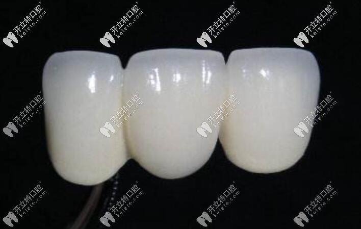 全瓷牙價格高但是美觀度好