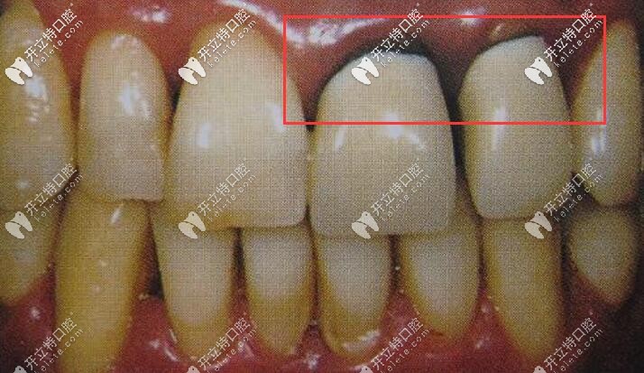 烤瓷牙價格便宜但容易有牙齦黑線