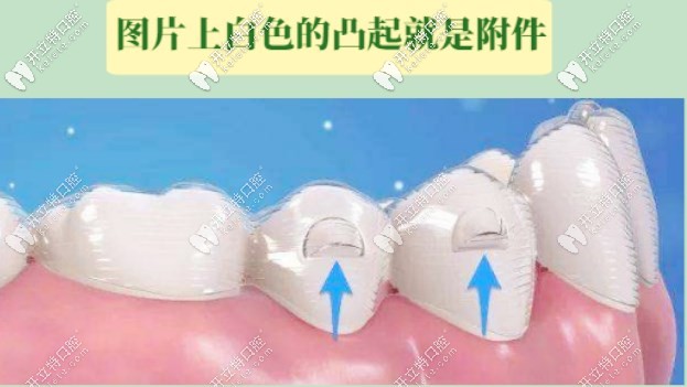 牙齒上留下的附件