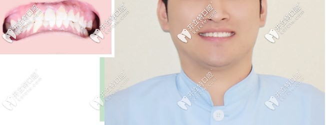 正畸醫(yī)生牙齒前凸戴隱適美隱形矯正，告訴你你不知道的事