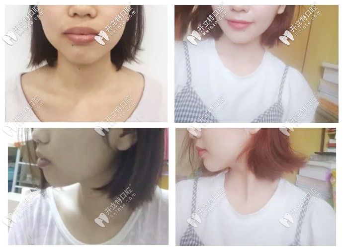 矯正前后的正面、側(cè)面對比