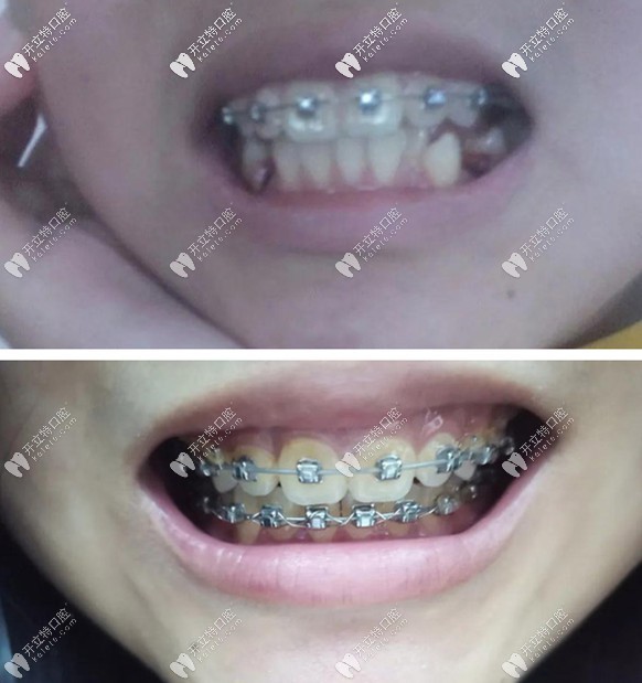 輕微齙牙矯正案例：16歲戴自鎖鋼絲牙套花了1萬(wàn)五