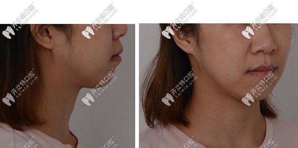 開(kāi)頜案例側(cè)面照 開(kāi)頜案例側(cè)面照