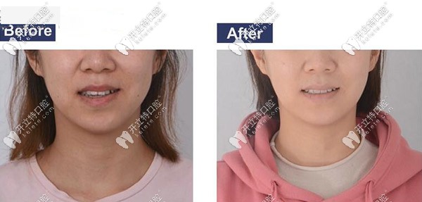 矯正前后臉型對(duì)比圖 矯正前后臉型對(duì)比圖