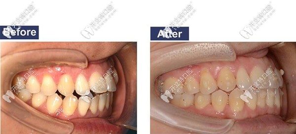 開(kāi)頜矯正側(cè)面圖 開(kāi)頜矯正側(cè)面圖