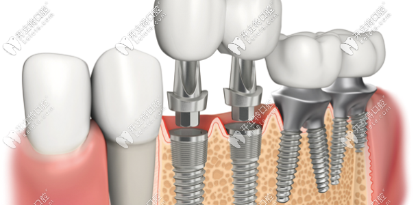 德國(guó)種植牙構(gòu)造