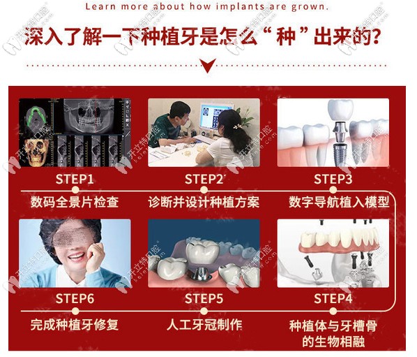 深入了解種植牙是怎么種出來的