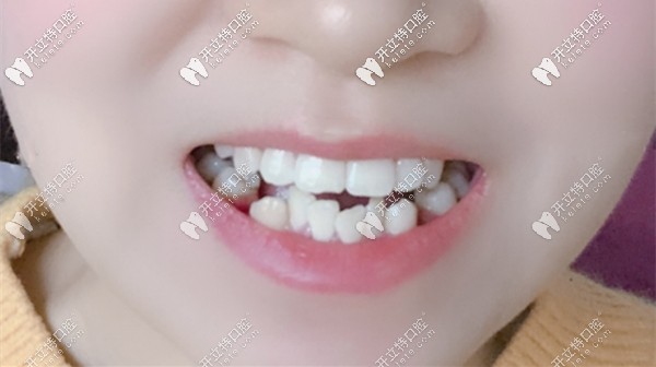 我做矯正前的牙齒樣子