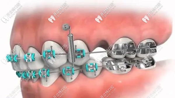 正畸過程打骨釘示意圖