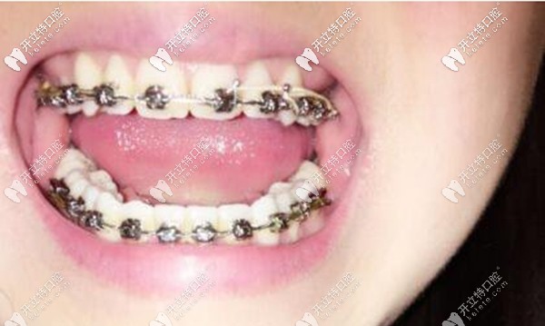 在晉城王國飛口腔做矯正一年多的效果圖