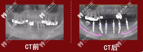 種植牙前后對比圖