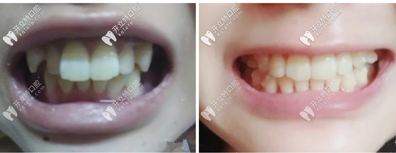 拔了4顆牙后做的隱適美，在濰坊戴隱形牙套的效果還不錯(cuò)