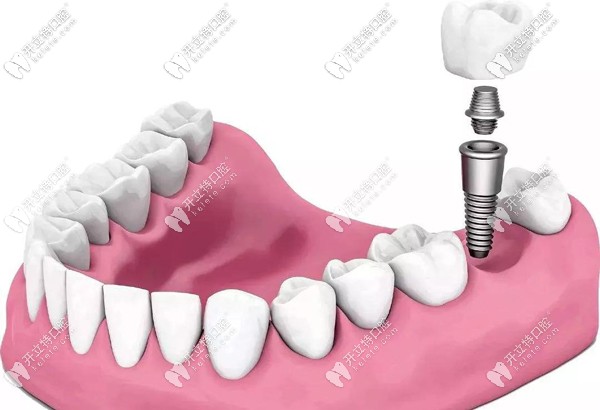 半口即刻種植牙的技術(shù)
