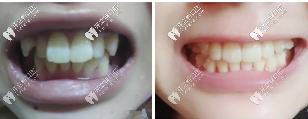 一年半的時(shí)間，牙套已經(jīng)變得<span style=