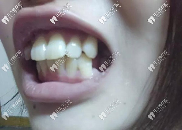 牙齒的側(cè)面照，外凸的厲害