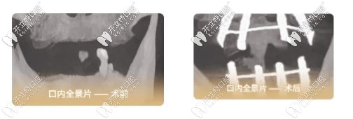 口內(nèi)全景片前后對比