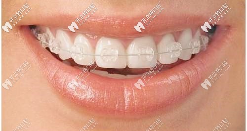 陶瓷半隱形矯正