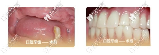 我75歲沒牙去做了全口all-on-4種植牙的經(jīng)歷，種牙過程很快