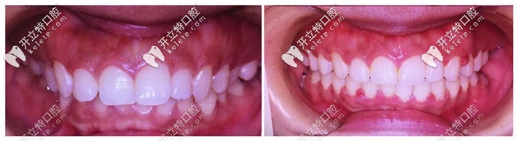 我做了Angelalign隱形矯正牙齒效果還不錯(cuò)，花多少錢都值得