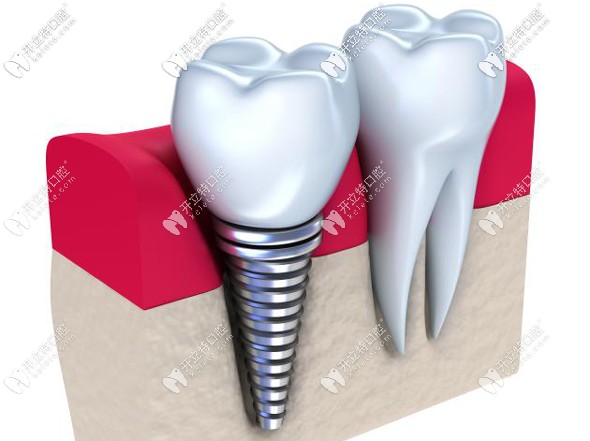 在廣州市做普通全口種植牙的價格參考