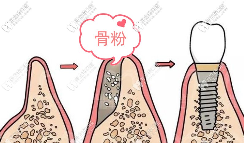 骨粉的價(jià)格是多少