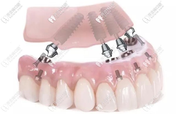 All-on-4全口種植技術(shù)及費用