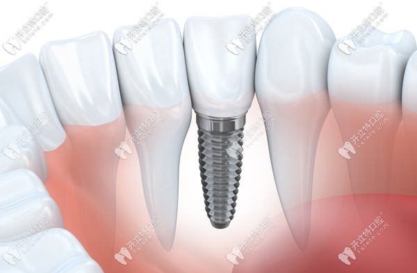 廣州全口種植牙多少錢?半固定種植4萬元+,allon4/6種植牙9萬元+
